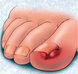 Hogyan lehet enyhíteni a gyulladást az ujjgyulladással, Miért gyulladták a lábujjak ízületeit